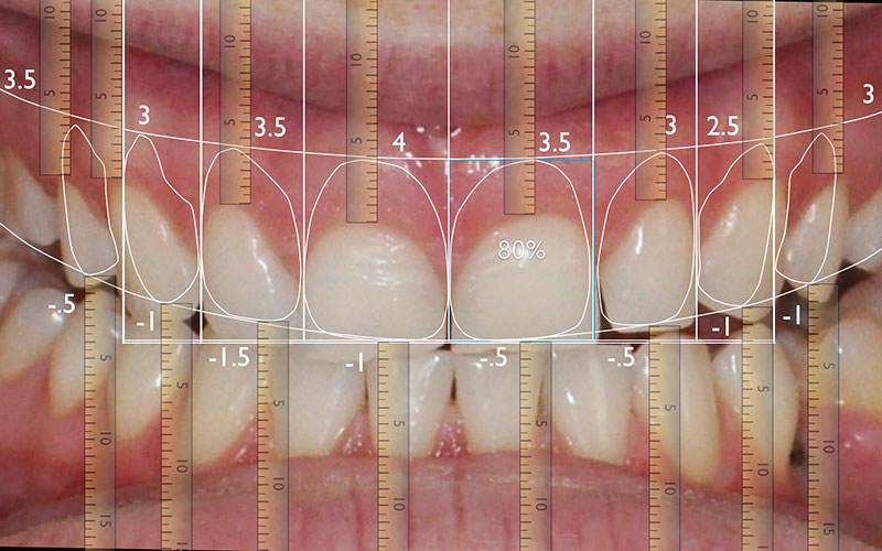 What is Smile Designing?