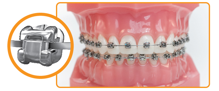 self ligating braces in chennai