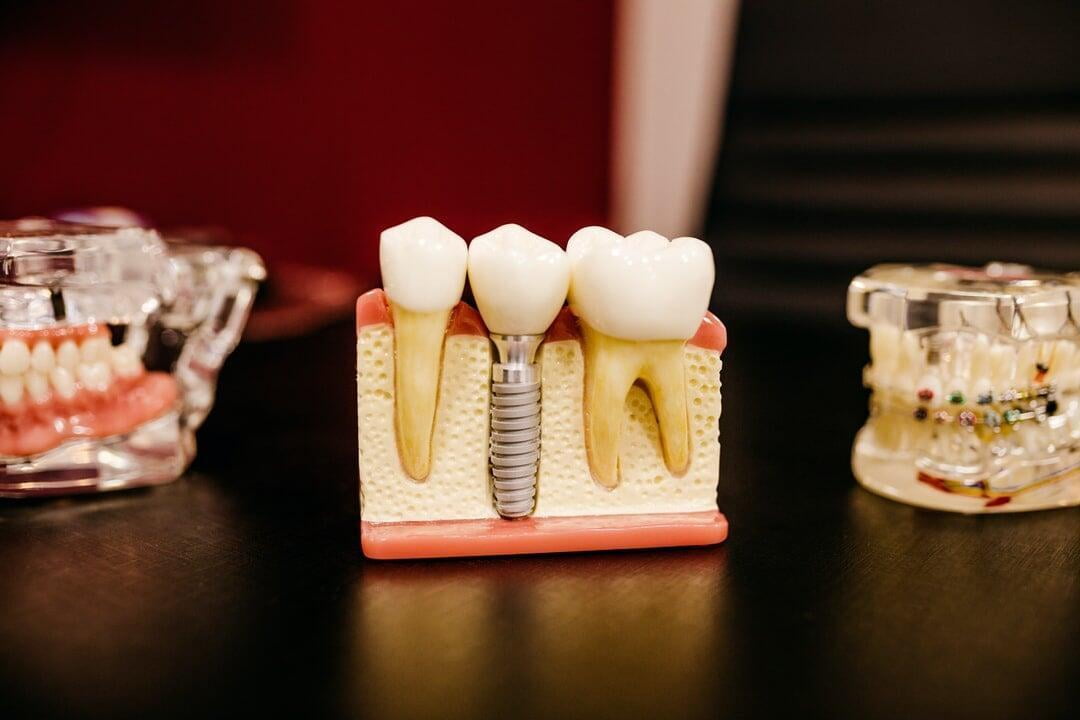 DENTAL IMPLANTS